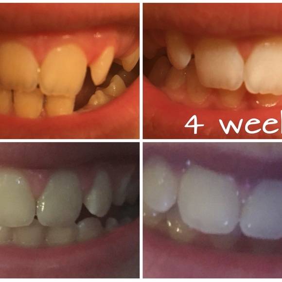 Whitening Toothpaste - Picture 14 of 16